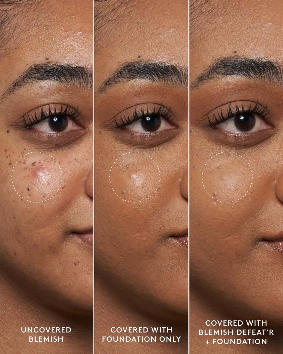 Blemish Defeat'r - Salicylic Acid Spot Treatment | Fenty Skin – Fenty  Beauty + Fenty Skin